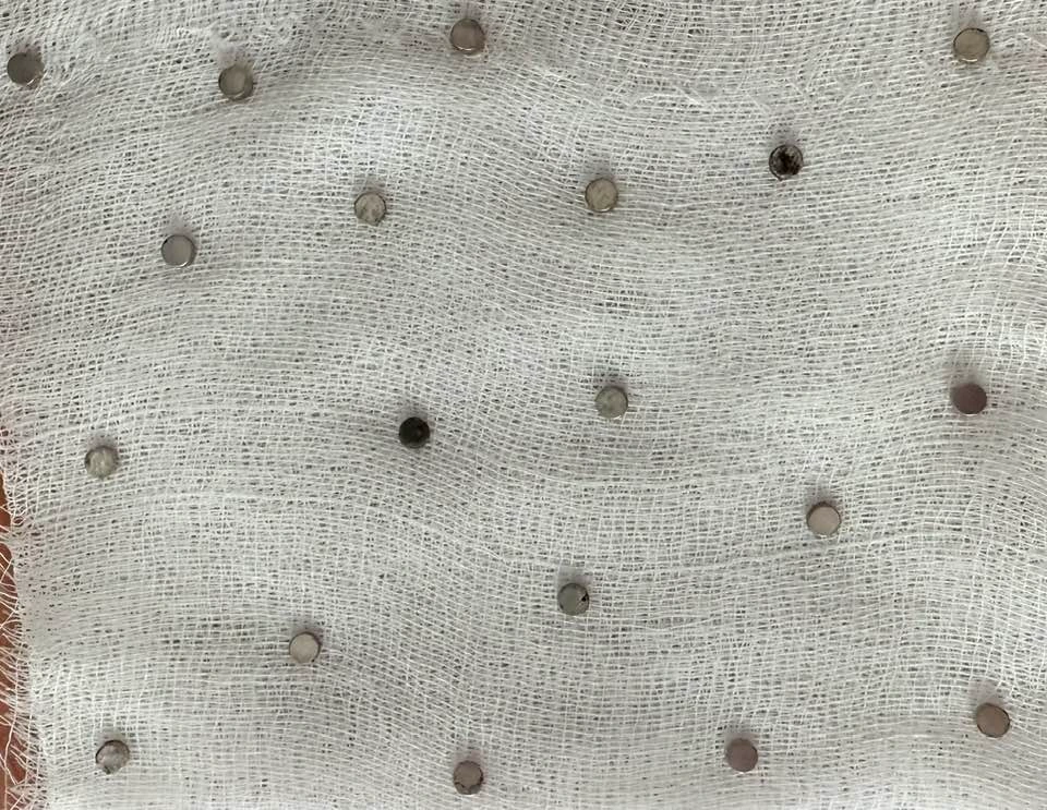 Elazığ’da yemek borusunu tıkayan 19 mıknatısı yutan 3 yaşındaki çocuk,